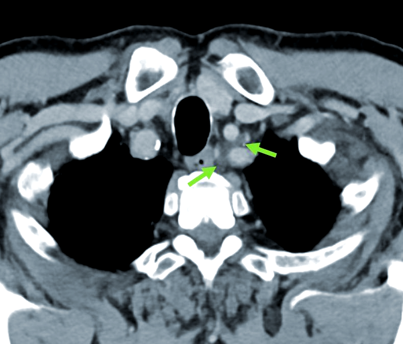 胸导管及其淋巴囊肿的ct影像特征详解