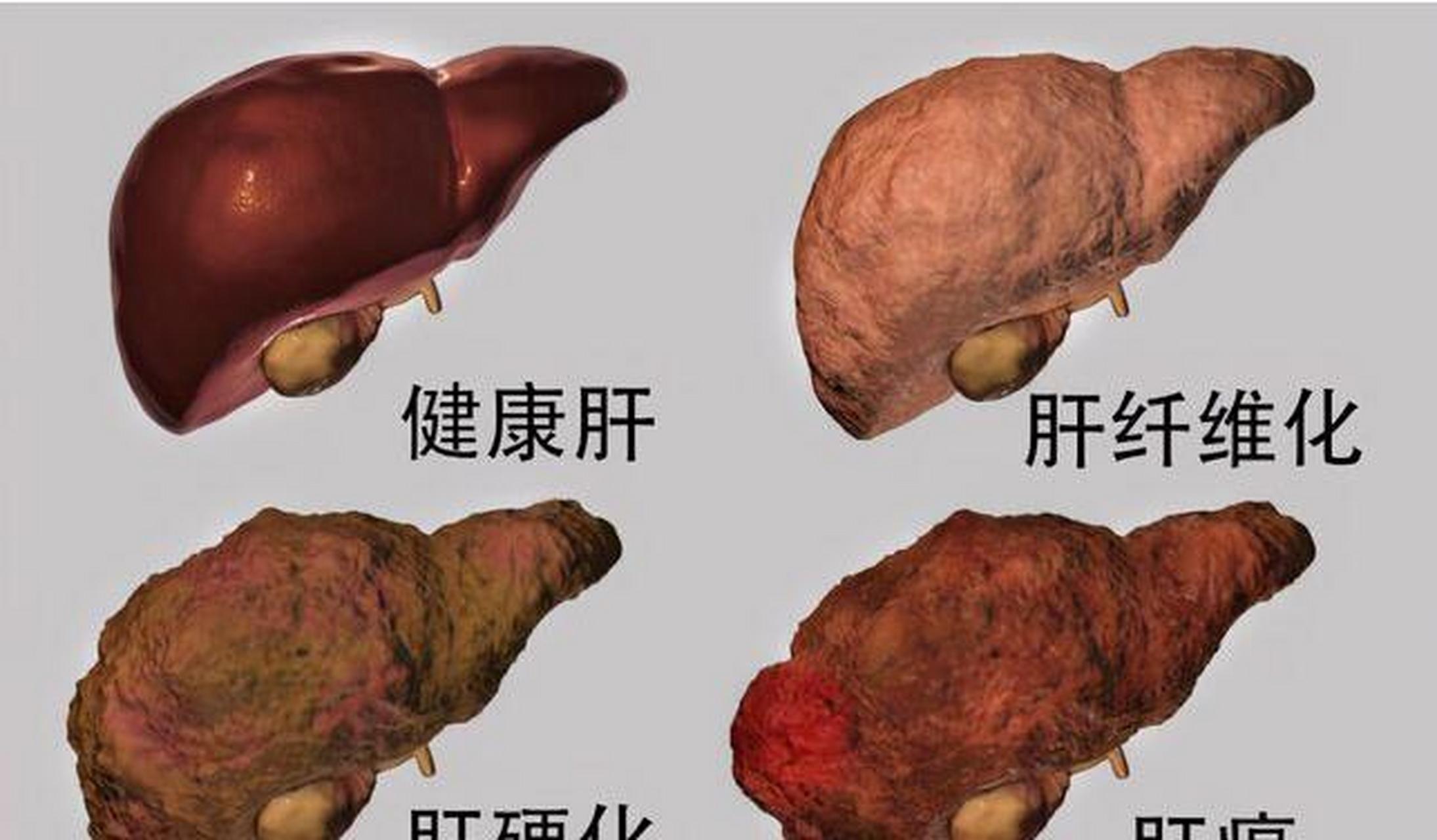 肝脏突然疼痛图片