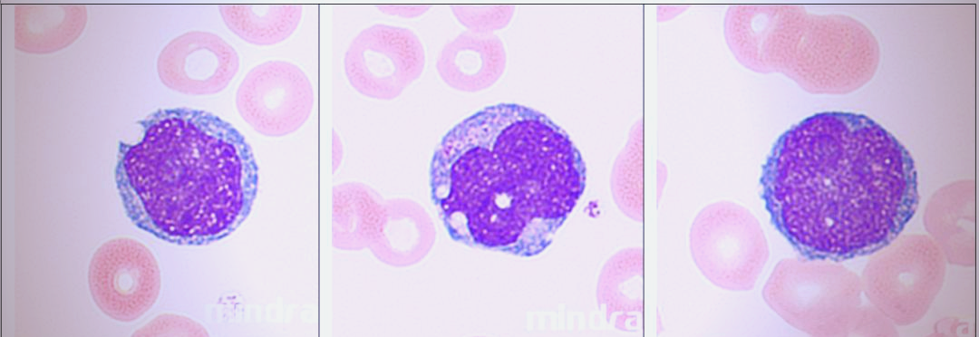 原幼单核细胞形态与诊断之间的微观探索