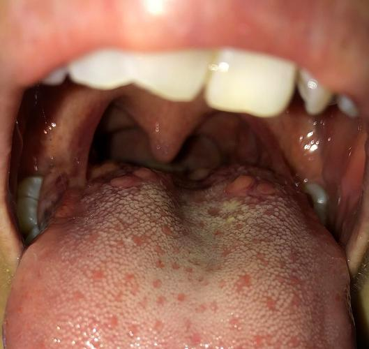 舌根突起疙瘩的原因与应对策略全面解析