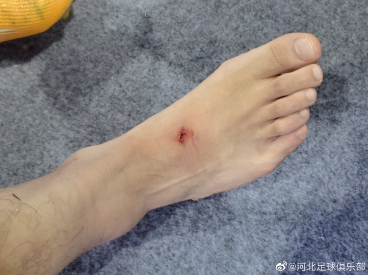 遭董岩锋飞铲,河北球员龚秋乐脚背踩踏伤及踝关节韧带损伤