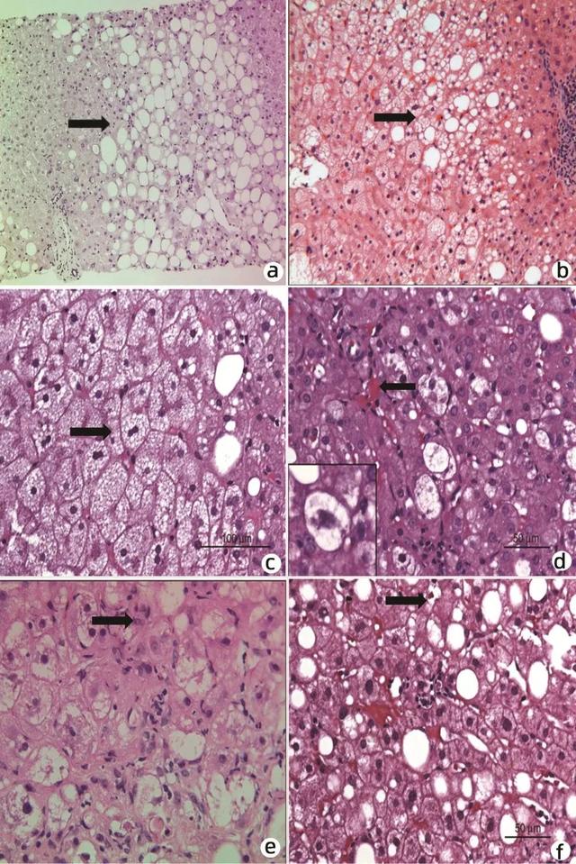 nafl的主要病理特征为肝细胞大泡性脂肪变性[2](图1),表现为细胞浆内