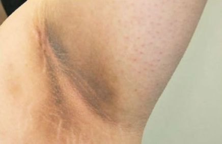 腋下长了黑棘皮,没想到是多囊卵巢的祸,金哲堂国医馆高金哲