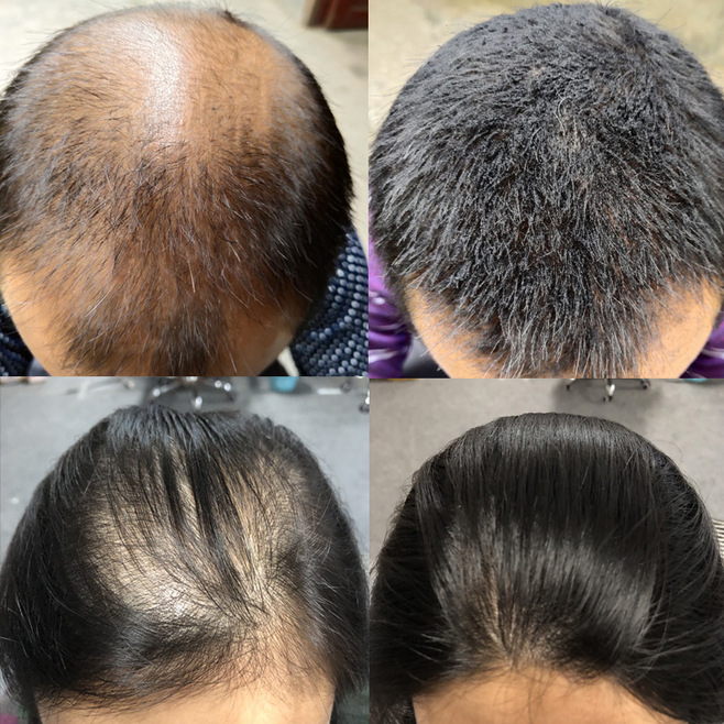 古芳栢草:为什么你总是脱发?点进来,详解脱发原因!