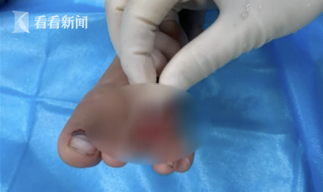 三岁男童"搬石头砸自己脚" 两根脚趾被砸断