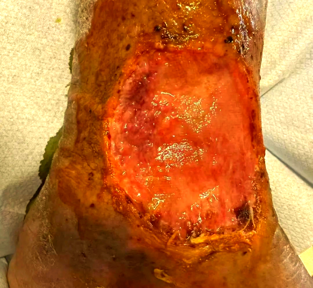 腿上出现小伤口竟可能引发严重后果警惕这些小腿症状