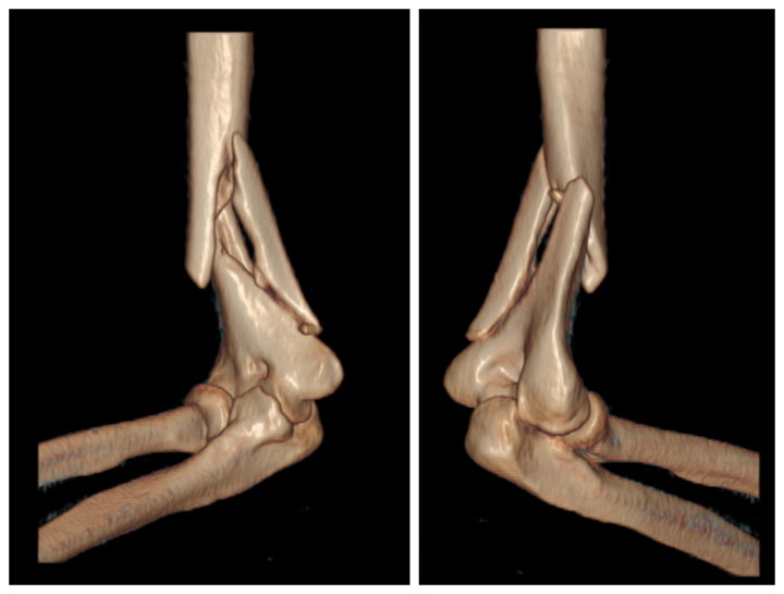 骑电瓶车摔倒致上臂骨折,济南南郊医院创伤骨科手术助康复