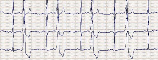室早二联律心电图图片