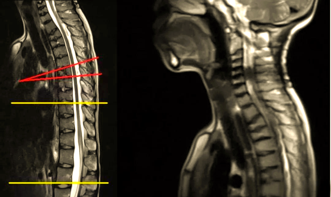 青少年驼背的病因与影像研究:休门氏病的深度解析