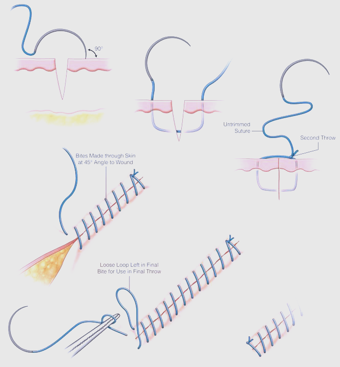 骨科缝合技巧大揭秘:从缝合原理到持针器使用,一篇全解!
