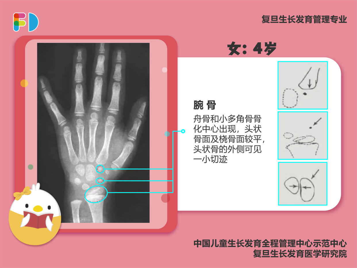 骨龄是骨骼年龄的简称,它是儿童生长发育水平的重要标志,也是判断儿童