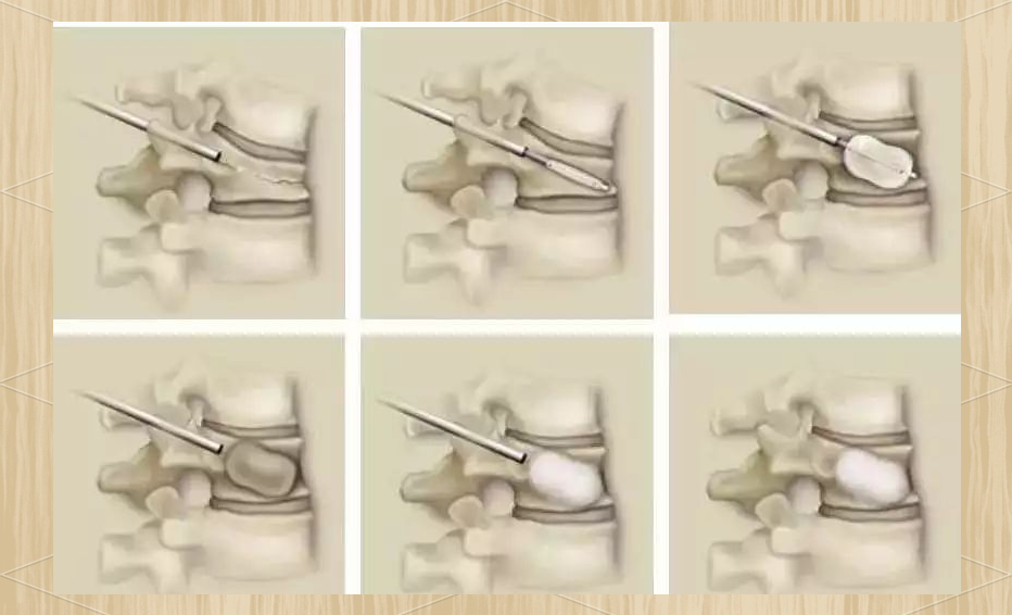 经皮椎体成形术:创新微创技术在脊椎治疗中的应用