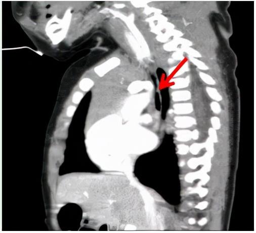 广州妇儿中心成功为3月龄"气管软化"宝宝实施胸腔镜下主动脉弓悬吊术