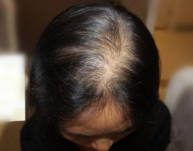 古芳栢草:脱发严重?看是不是得了这几种病?