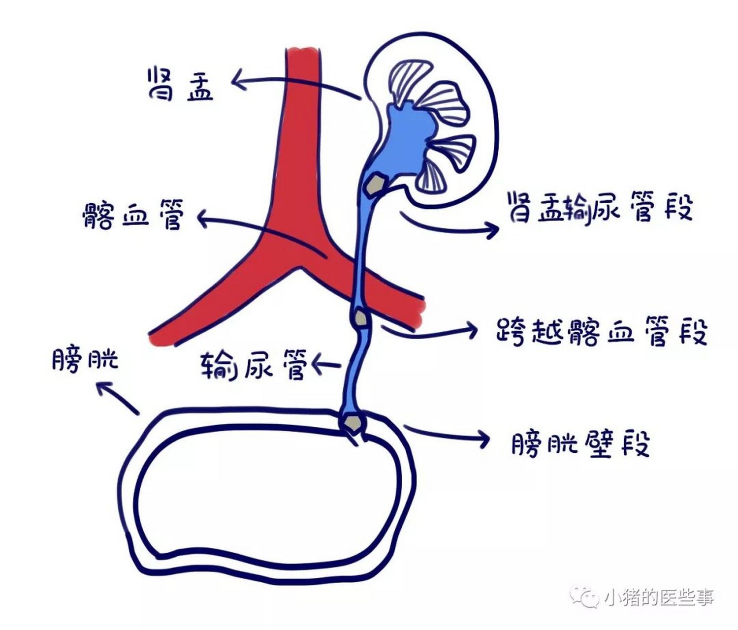 输尿管的3个生理性狭窄,也是肾结石最容易卡卡壳的地方