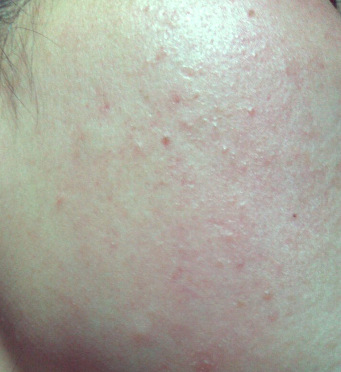 皮肤过敏的多种典型症状,助你正确识别与应对