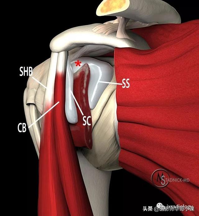 「高清解剖」肩关节周围滑囊,精美高清图解,值得收藏