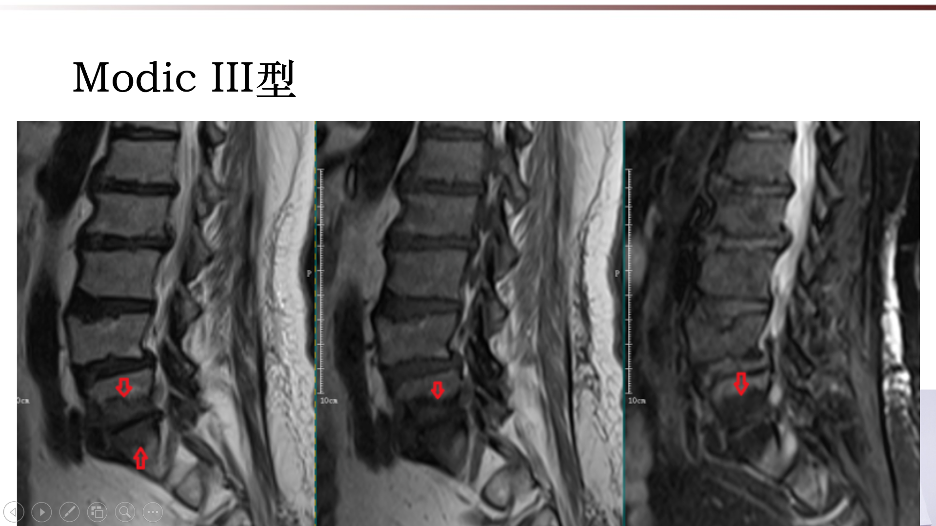 许莫氏结节及终板炎影像诊断