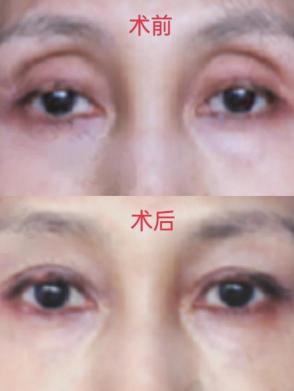 50岁女士做眼窝凹陷填充,术后效果对比鲜明,简直惊呆了!
