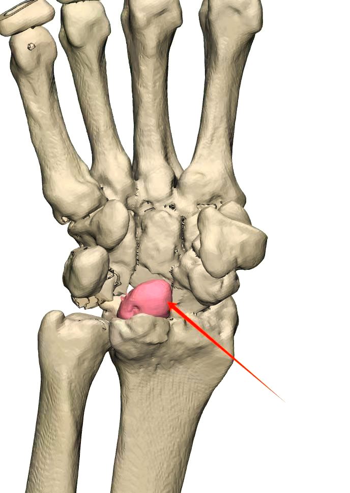 上饶市人民医院成功实施首例3d打印个性化定制人工月骨置换术