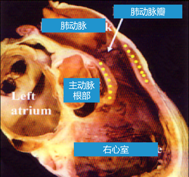 动脉圆锥在哪里?有什么用?