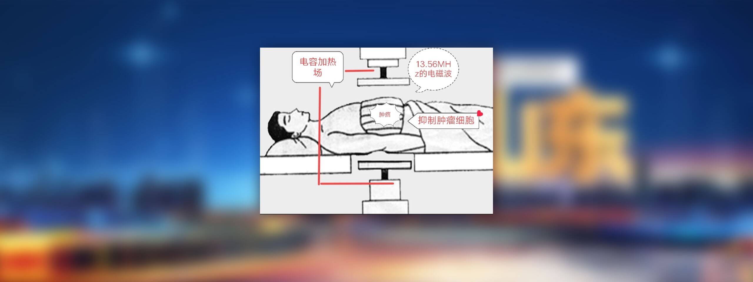 肿瘤热疗是如何"热死"肿瘤细胞的?