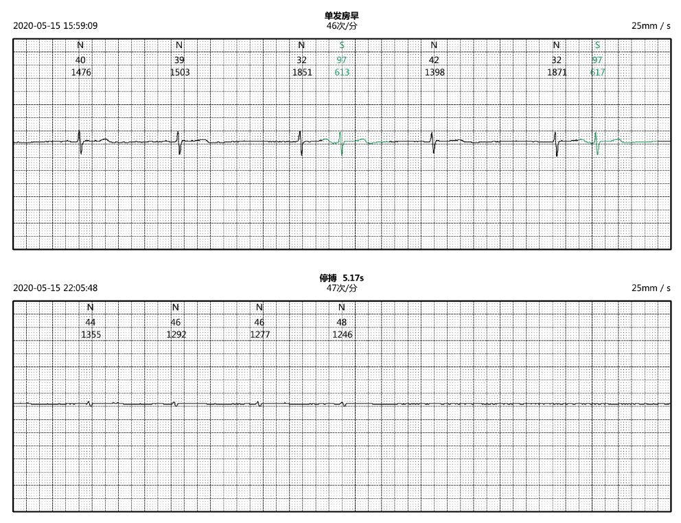 卡帕奇心電貼臨床應用病例分享(六)|竇緩心律患者多次停博