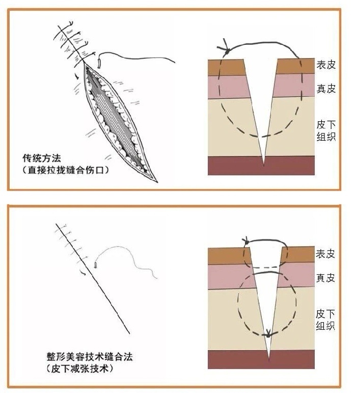 伤口缝合方法图解图片