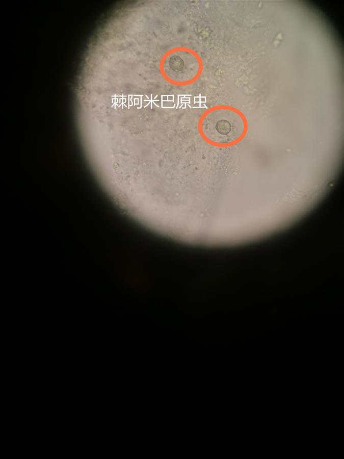 男子图方便用自来水冲洗隐形镜片,感染棘阿米巴原虫险失明
