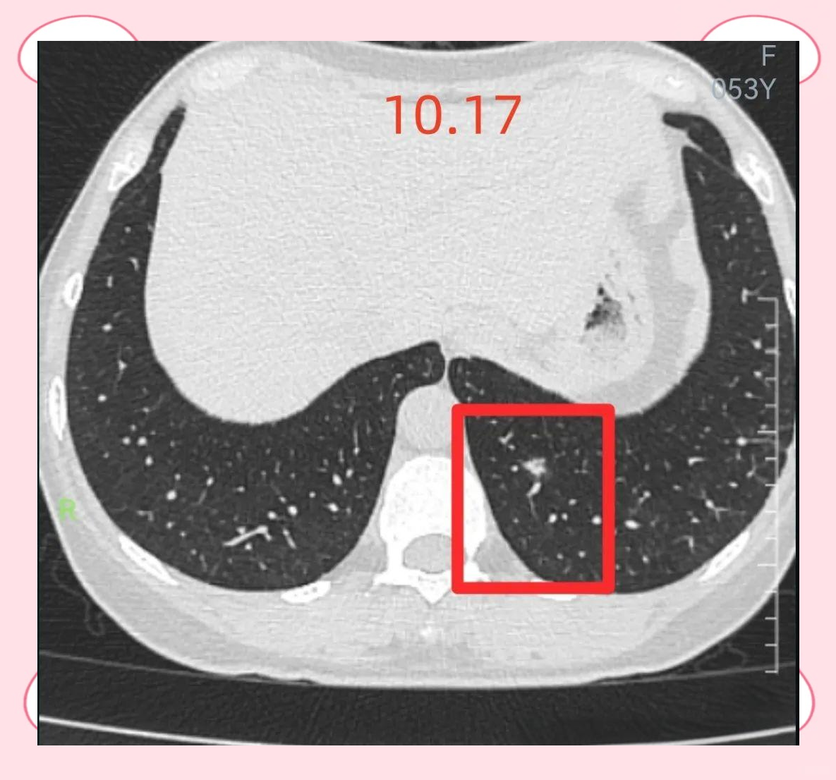 肺结节影像诊断争议:炎症与恶性之间