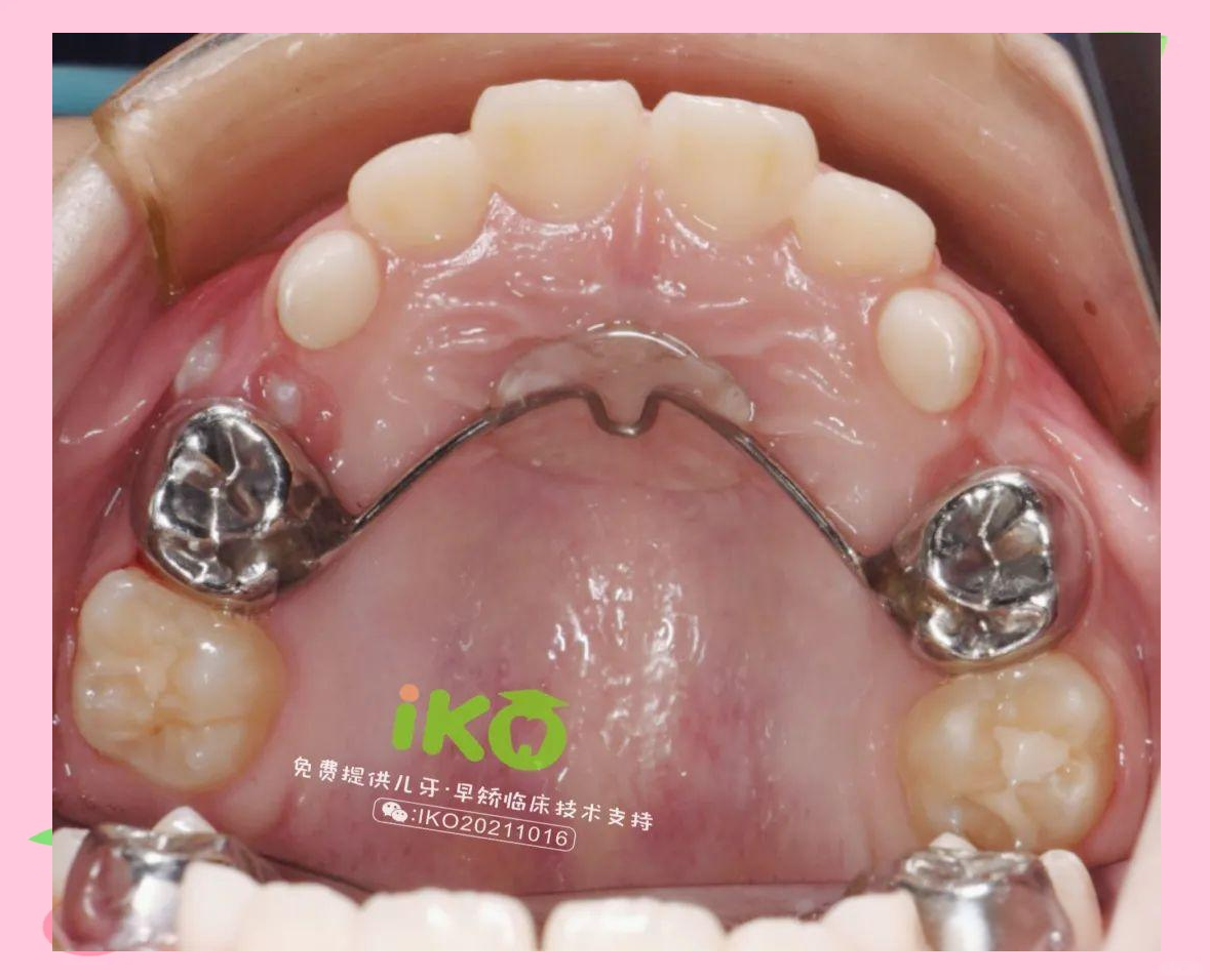 多种间隙保持器在后牙区多颗牙齿缺失中的应用