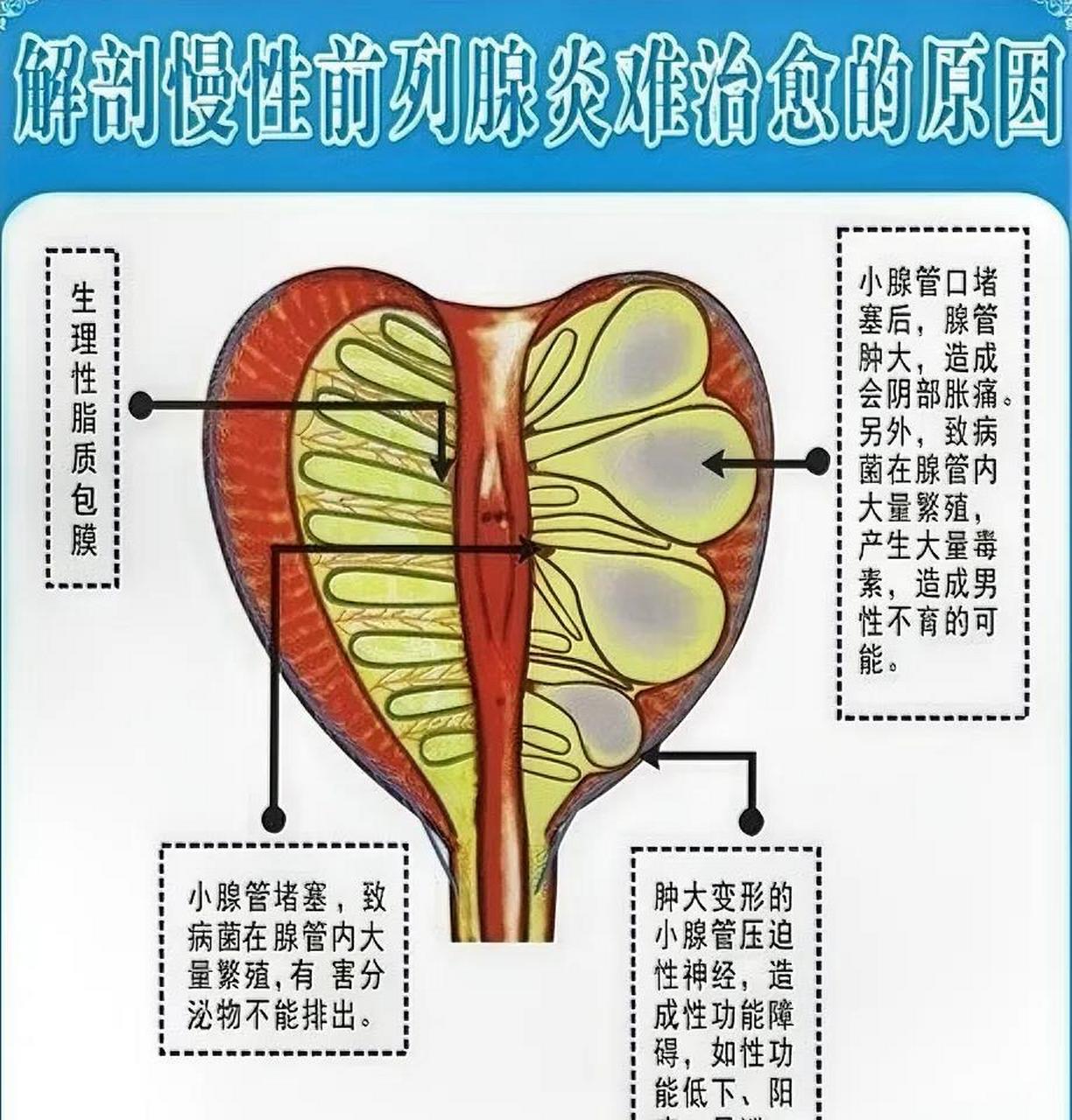 从解剖结构上看,小腺管口堵塞后,腺管肿大,压迫神经,造成会阴部胀痛不