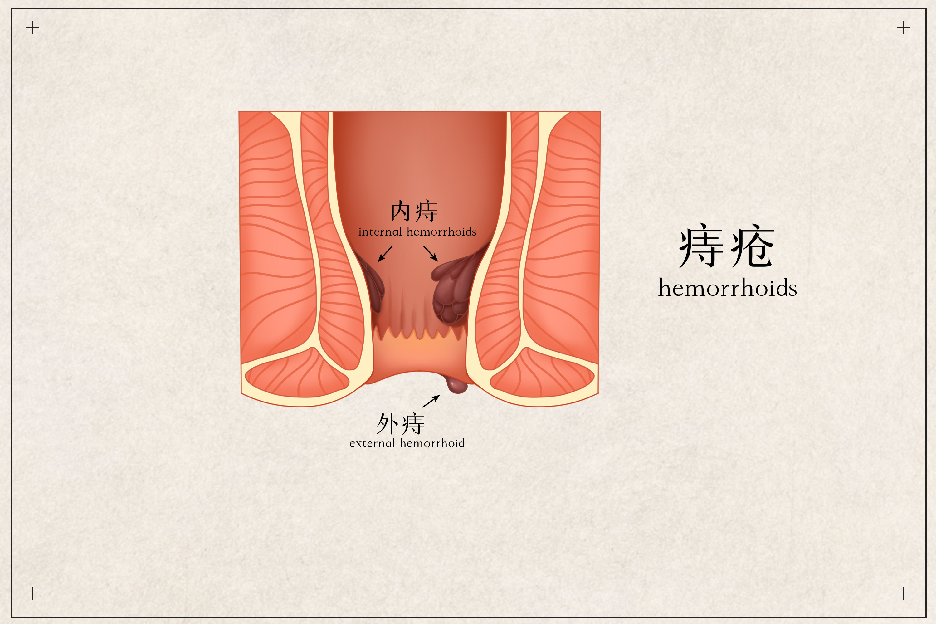 包头东大肛肠专科医院详解痔疮与肛裂如何区分?