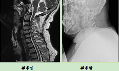 颈椎后路双开门手术图图片