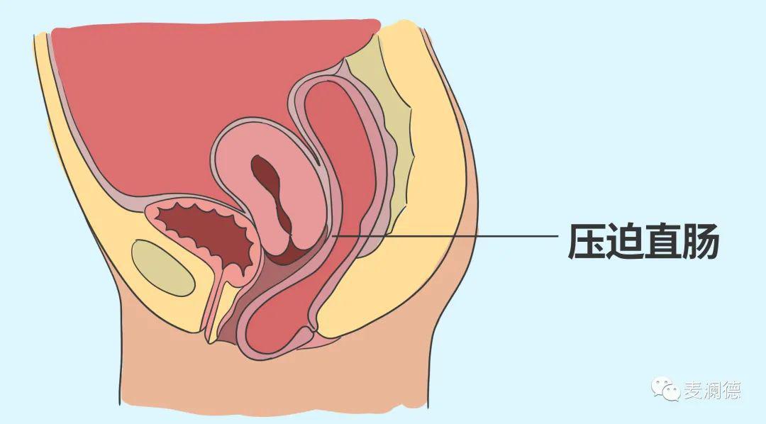 子宫下垂有什么症状图片
