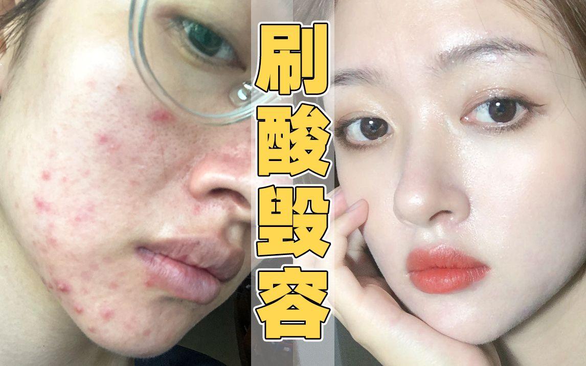 关于刷酸,你要知道这些!