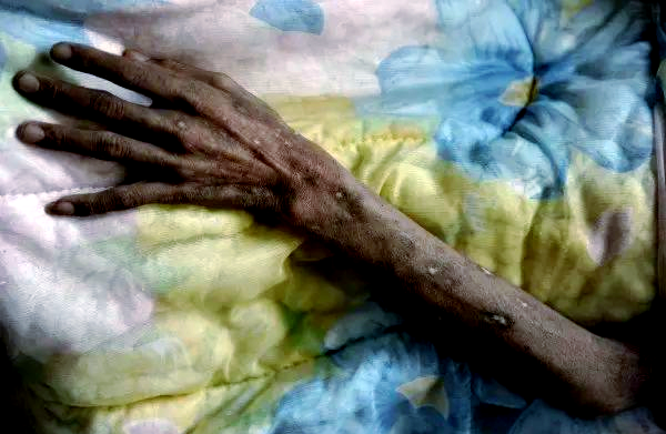 艾滋病晚期病人照片,令人震惊!