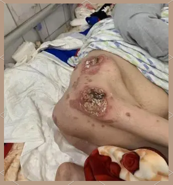 深入探索:艾滋病患者的真实生活与挑战