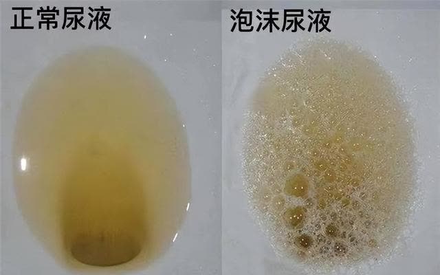 尿酸高,小便先知,医生提醒:若小便出现这3种表现,尽早检查