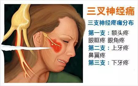 三叉神经痛的症状图片