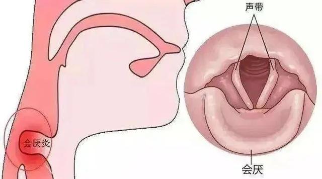 "急性会厌炎"是什么病,竟然这么凶险?平时应该注意些什么