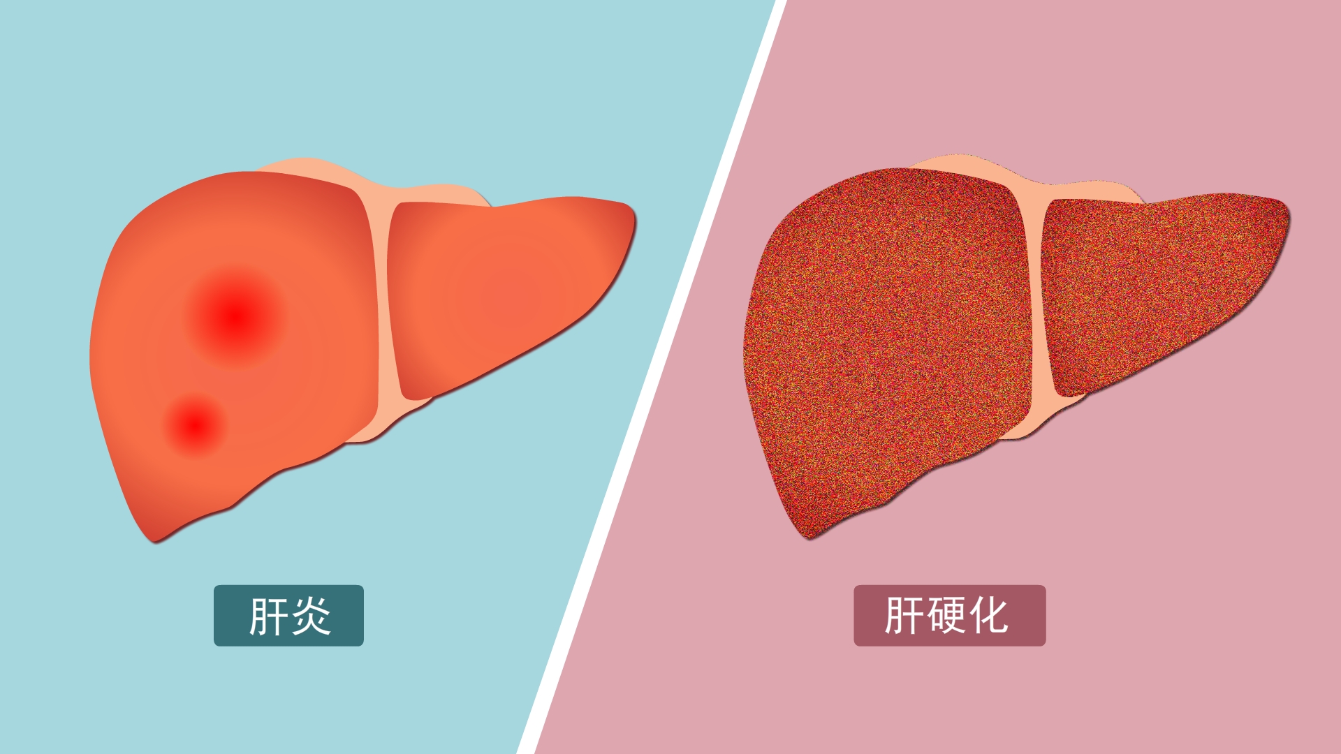 36岁业务员,查出肝硬化,痛哭:身体早有提醒,只是自己没当回事