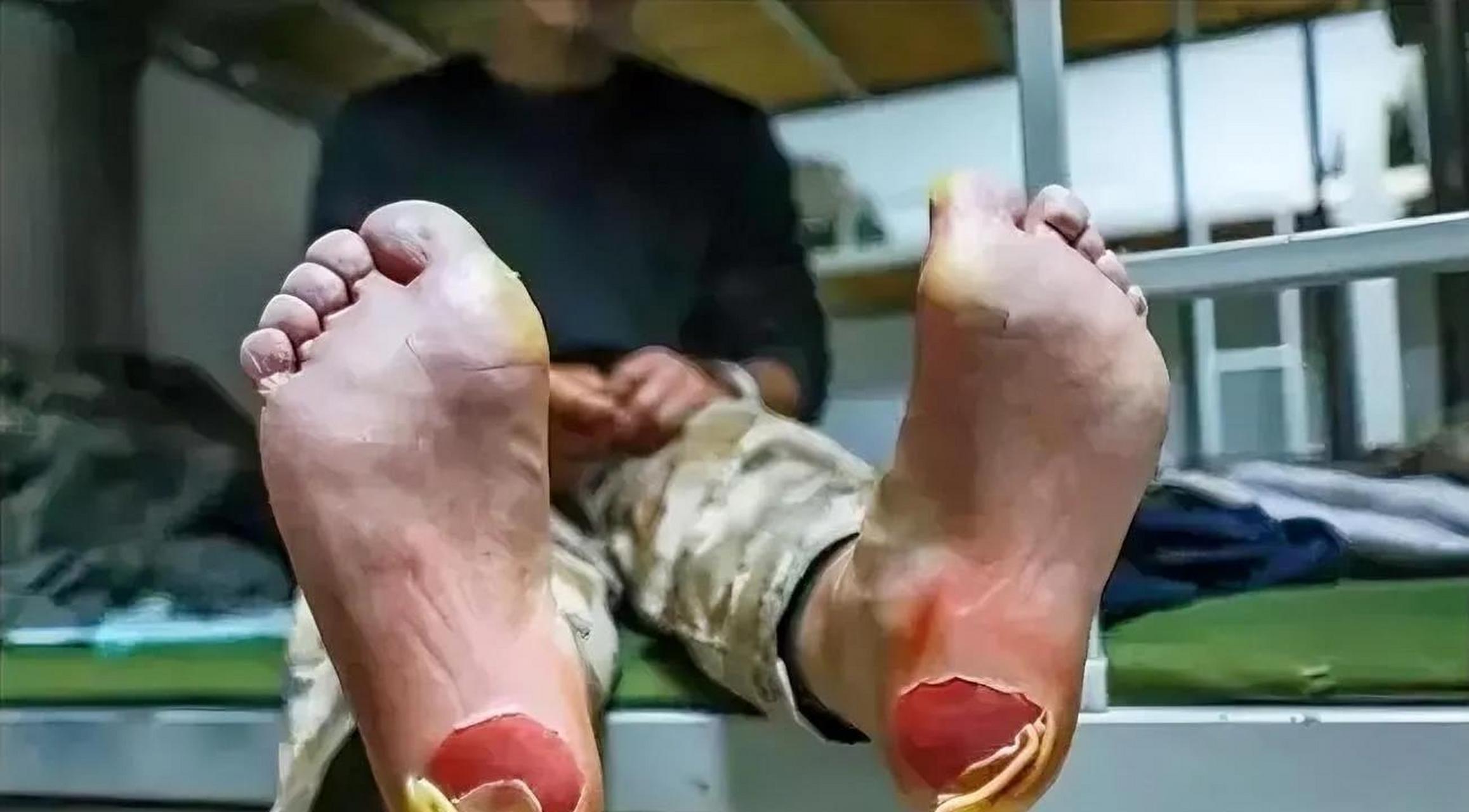 经过这次越野之后,老茧被完全的磨掉,看起来鲜血淋漓.