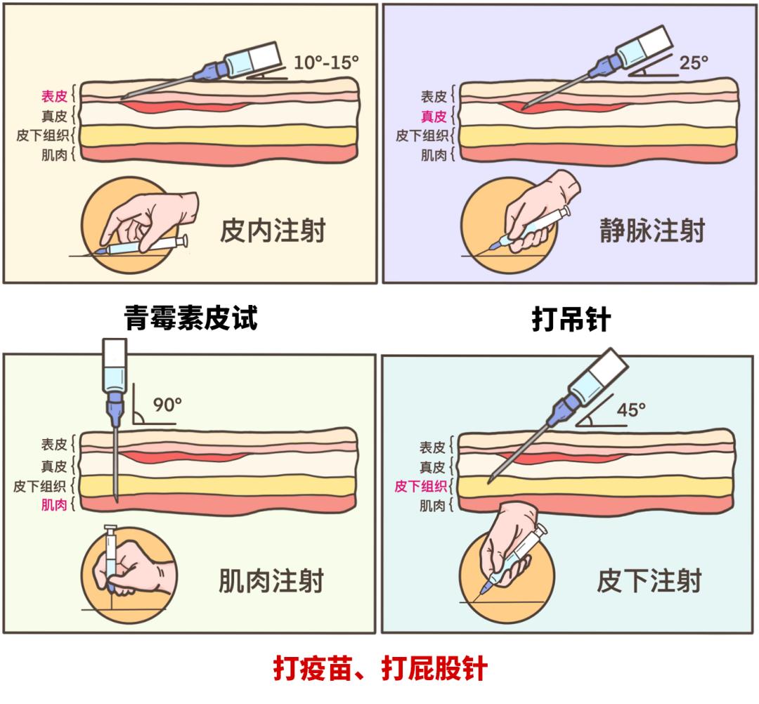 同样是打针,为什么有的打胳膊,有的打屁股?