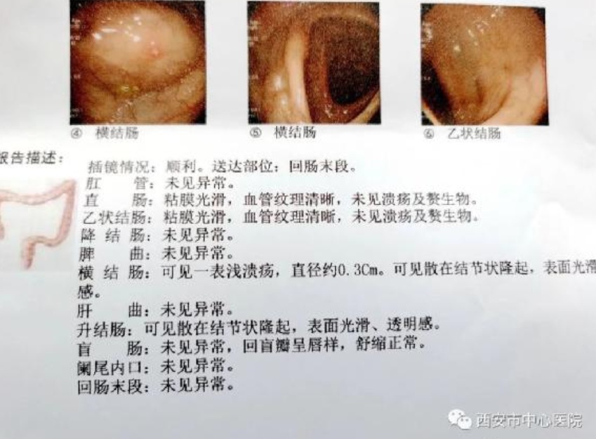 西安市中心医院"结肠气囊肿"的最佳治疗方法—高压氧治疗
