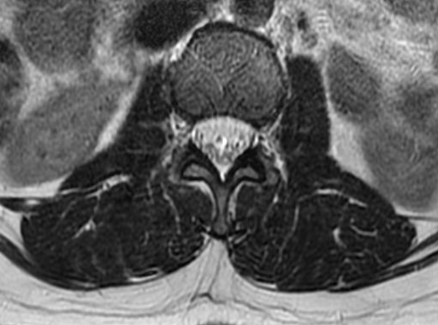 终丝脂肪沉积(fatty filum terminale)