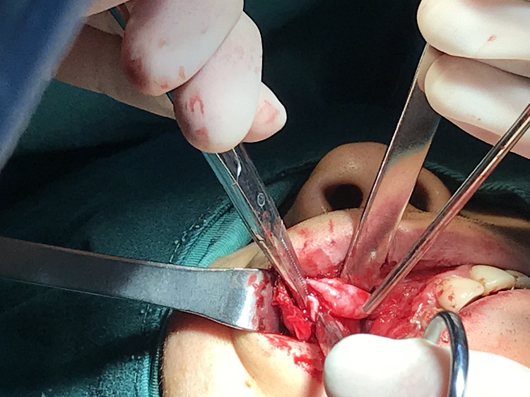 额窦炎微创手术过程图片