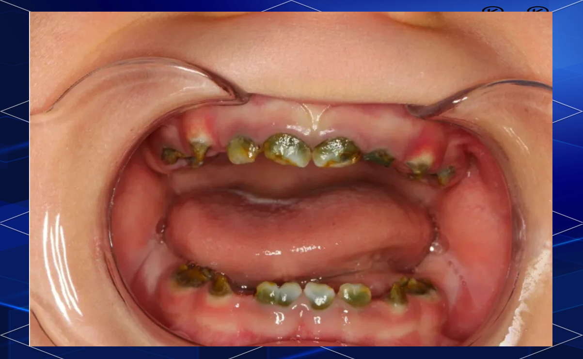 梅毒牙的辨识与预防