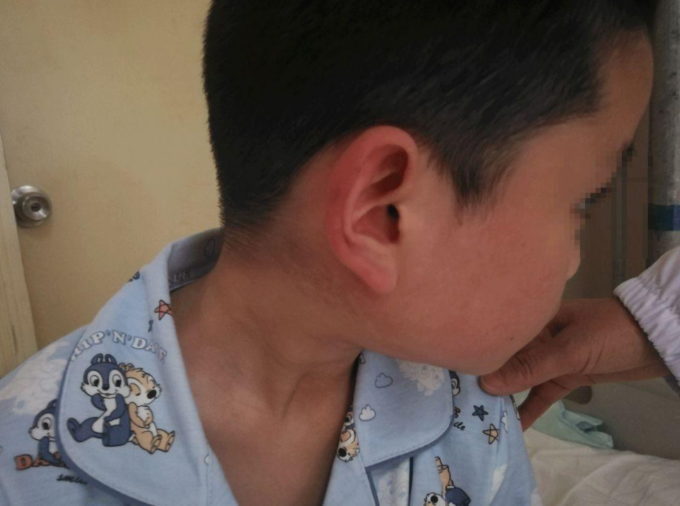 "腮帮子"又肿起来了?这样做能治疗流行性腮腺炎!