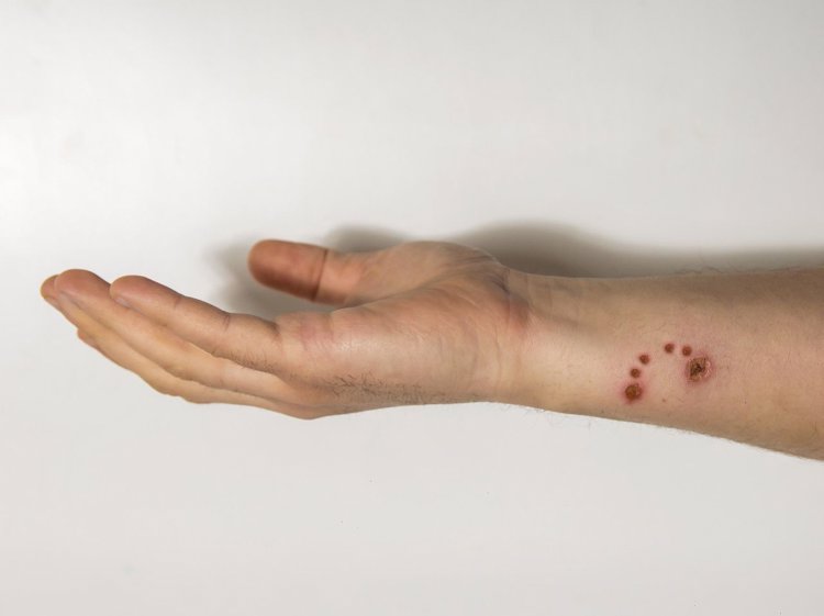 30岁男子"狂犬病"发作身亡,去世前已注射疫苗,为何人还没了?